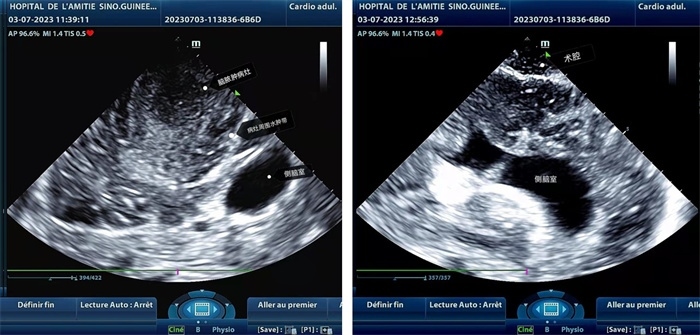 左圖顯示術(shù)中超聲見囊實(shí)性病變，大小約為4x4x3cm，病灶周圍腦組織水腫明顯；右圖為病灶切除后，術(shù)中超聲示術(shù)腔無病變殘留