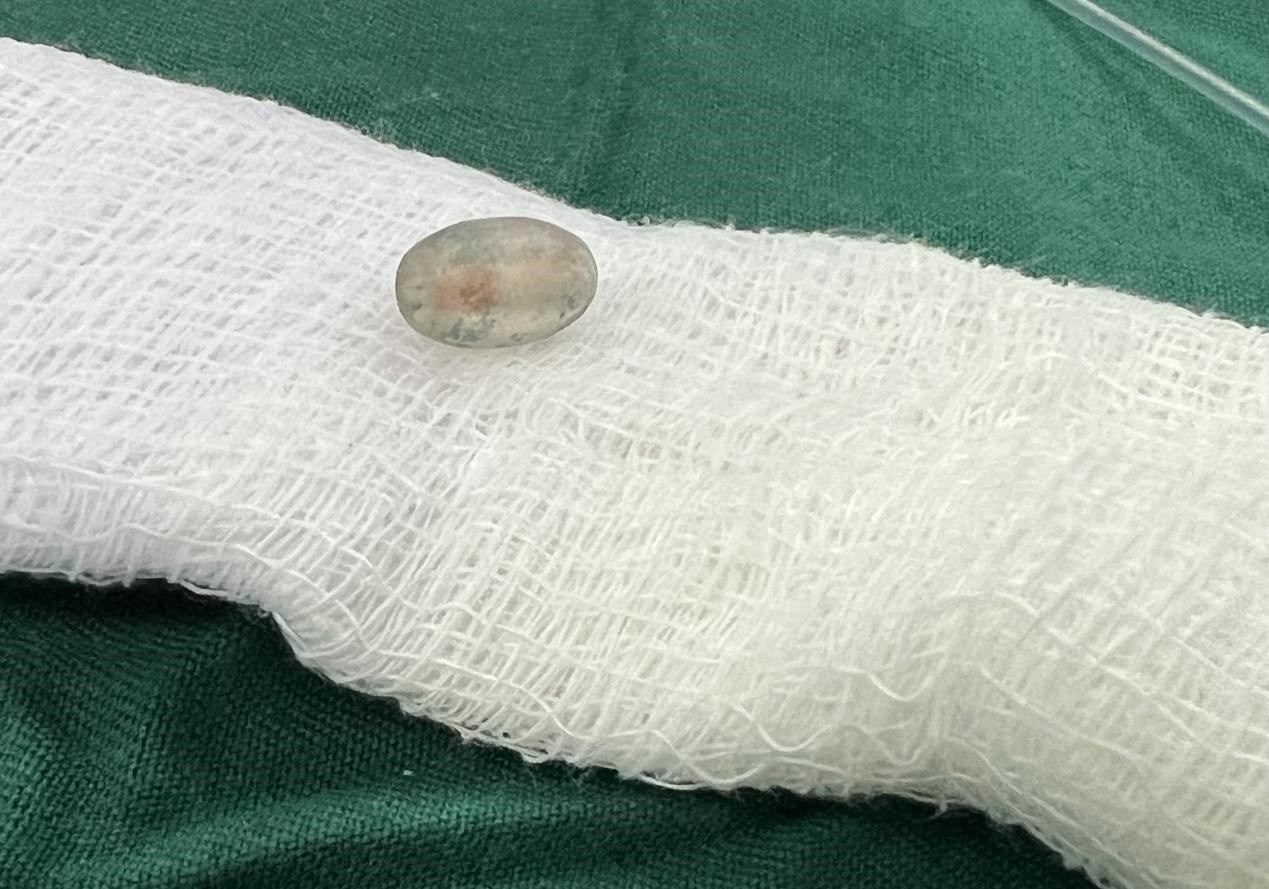 被取出的異物。中國援桑醫(yī)療隊供圖