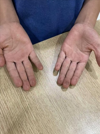 9歲小學(xué)生長期拍煙卡，手部粗糙長繭。受訪者供圖