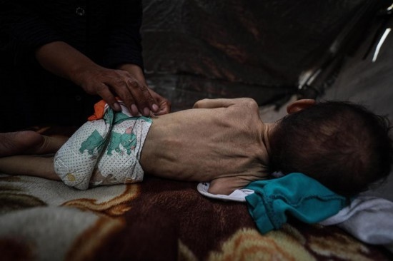 這是5月28日在加沙城西部一處臨時安置點拍攝的一名營養(yǎng)不良的嬰兒。新華社發(fā)（馬哈茂德·扎基攝）
